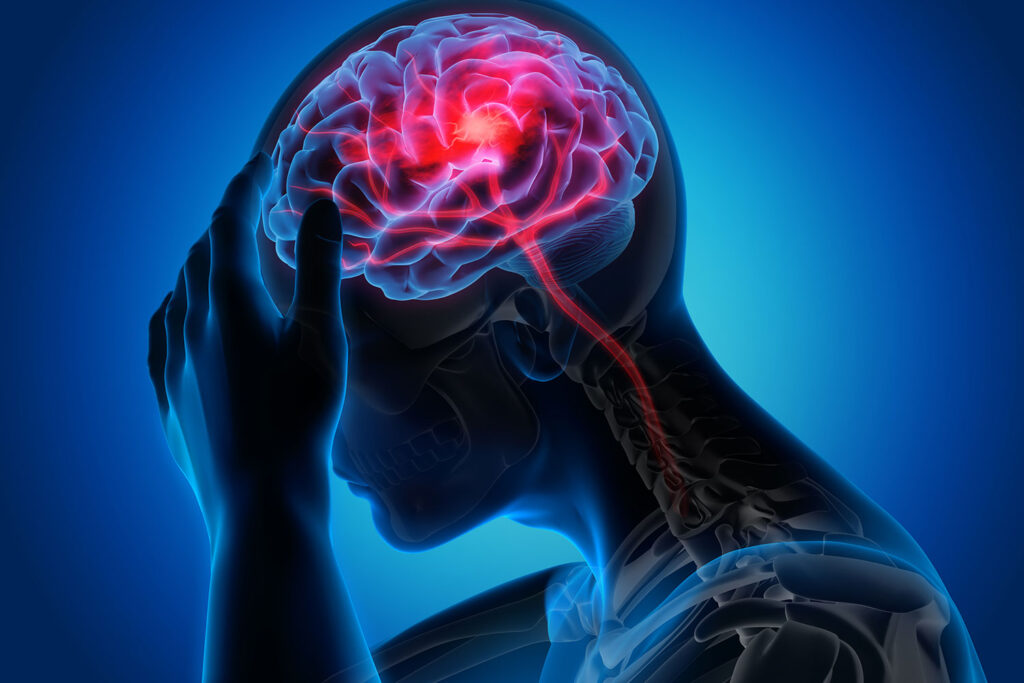 Migraine prophylaxis is key for Migraine Headache Sufferers
