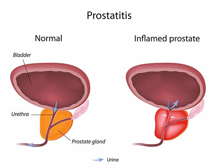 Prostatitis chronic pelvic pain syndrome
